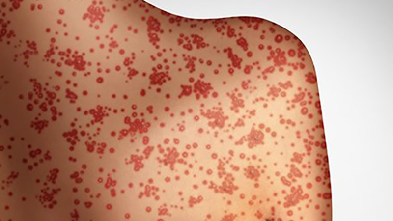 Kansas City Health Department confirms measles case in unvaccinated adult.