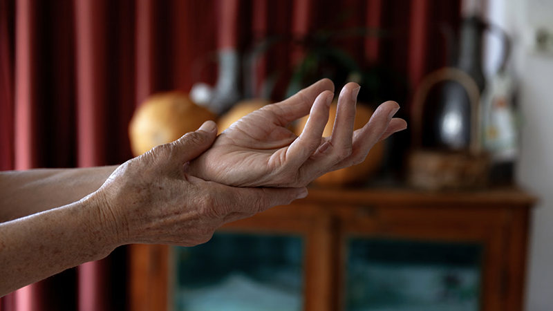 Psoriatic Arthritis Treatment: Expert Strategies for Managing Symptoms