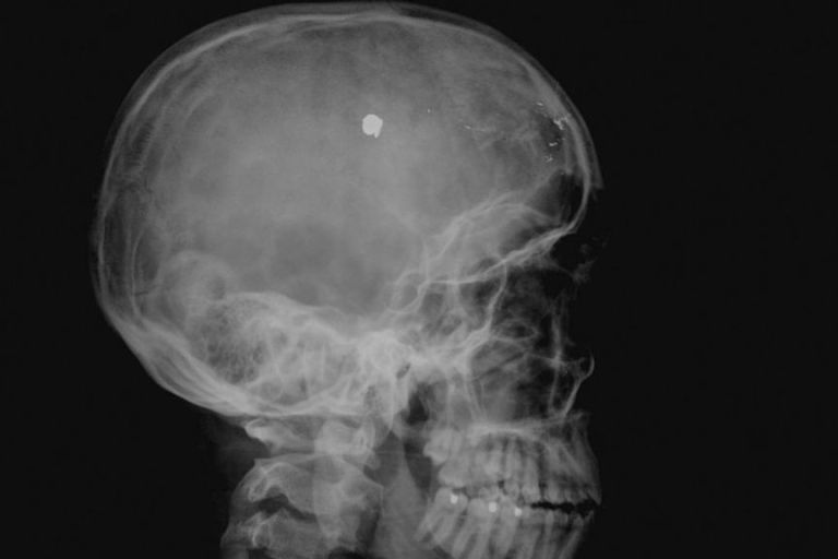 Tough Nut: Nurse With A Mugger’s Bullet In His Brain For 10 Years 