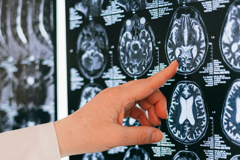 Predicting Possible Alzheimer’s With Nearly 100 Percent Accuracy: Study