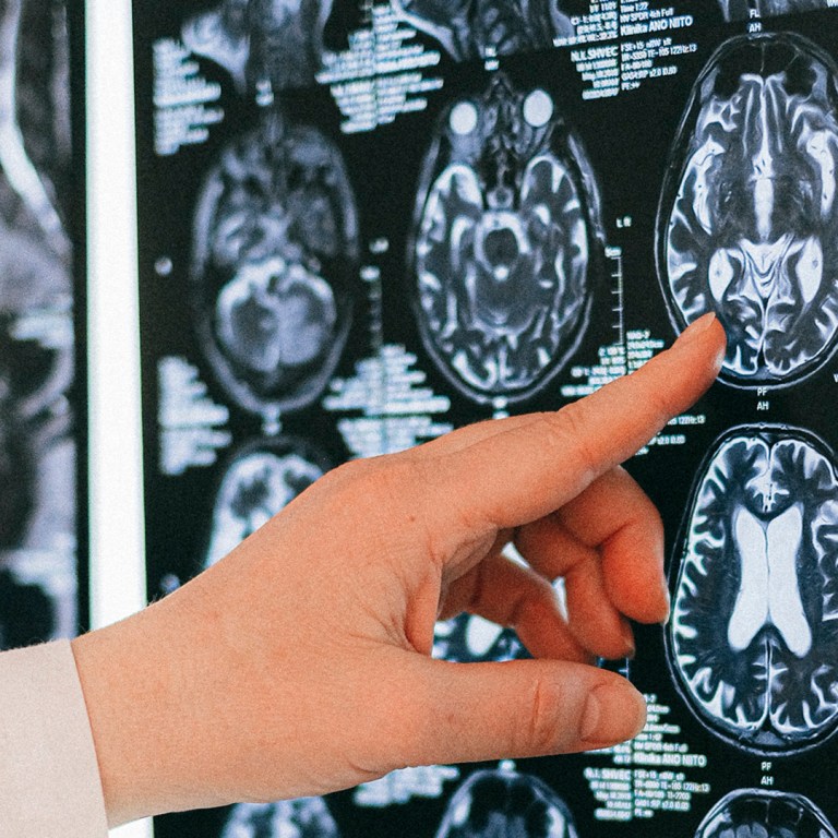 Predicting Possible Alzheimer’s With Nearly 100 Percent Accuracy: Study