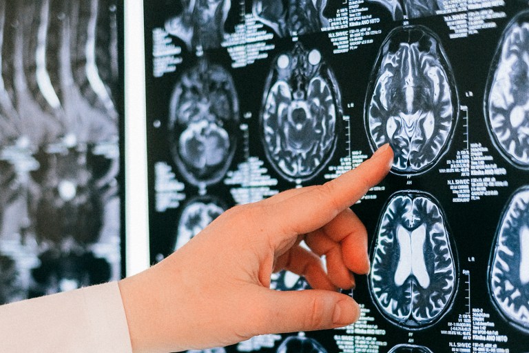 Genetic Risk Scores Can Aid Accurate Diagnosis Of Epilepsy