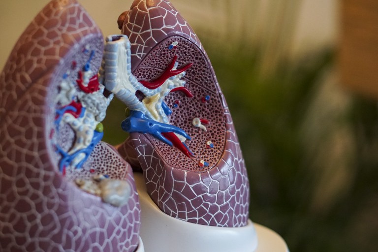 Researchers Attempt Better Understanding Of Cystic Fibrosis