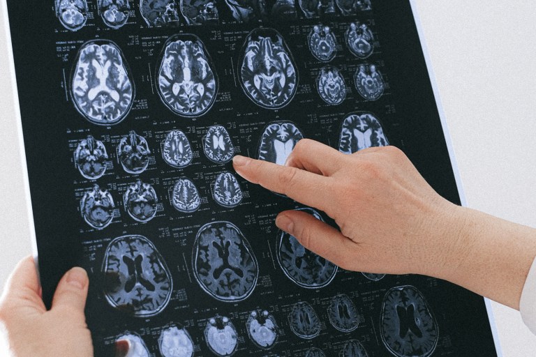 Researchers Find Promising Results For Parkinson’s Disease Treatment
