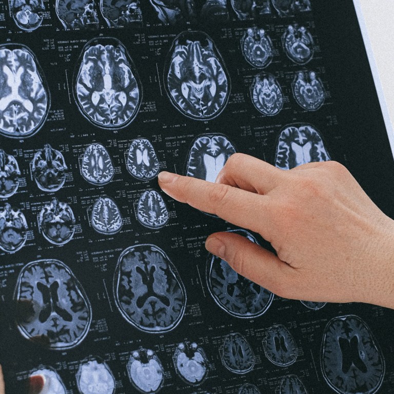 Researchers Find Promising Results For Parkinson’s Disease Treatment