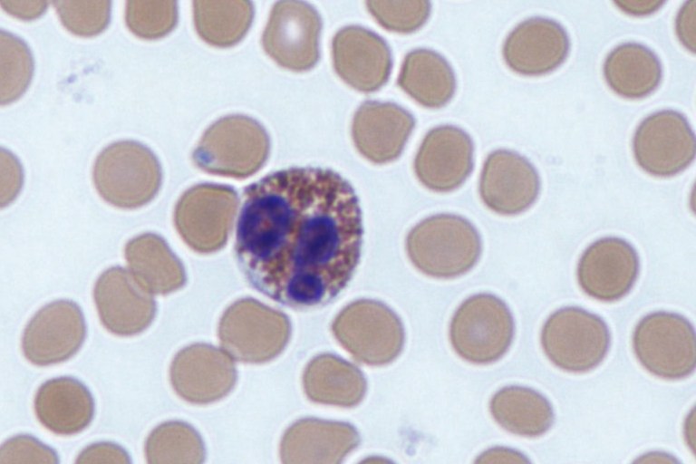 White Blood Cells May Be Harnessed To Boost Cancer Immunotherapy