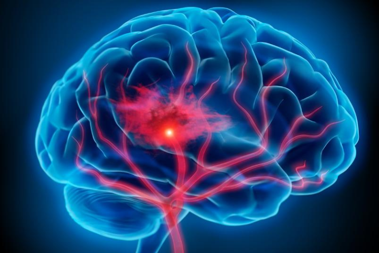 AARP Matters: Why More Middle-Aged Adults Are Having Strokes — and How to Prevent One