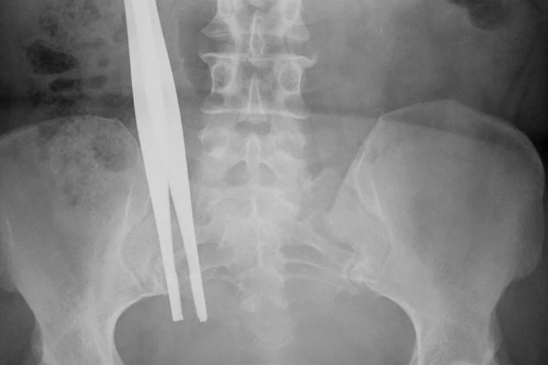 Hidden Dangers in the Operating Room: The Problem of Surgical Items Left Inside Patients