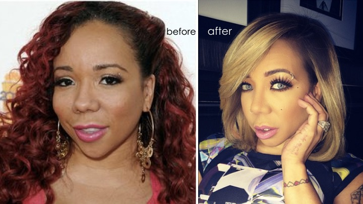 Tameka “Tiny” Harris: 10 Years After Permanent Eye Color Surgery