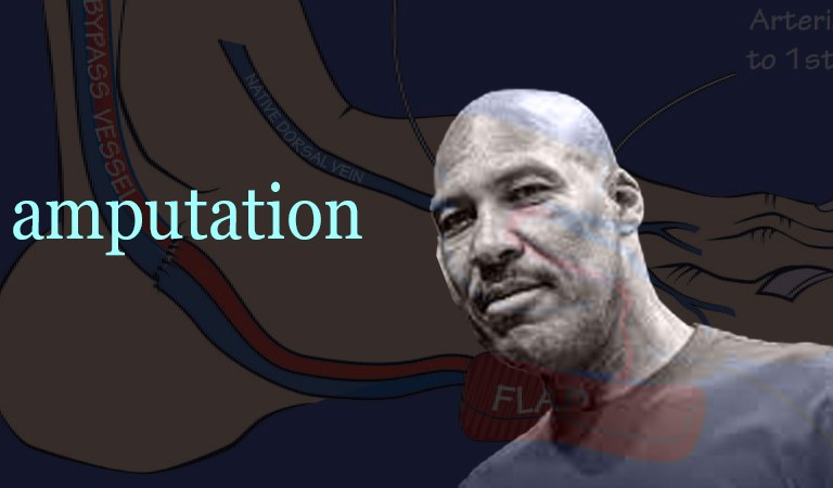 LaVar Ball’s Amputation Sheds Light on a Health Crisis