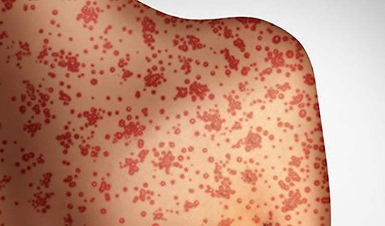Measles Outbreak and People Living with HIV