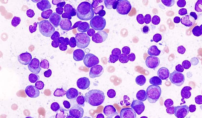 Not a Good Word to Hear: You’ve got Multiple Myeloma