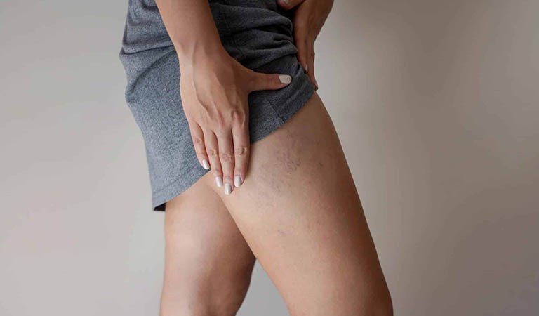 5 Hidden Blood Clot Signs You Should Not Ignore