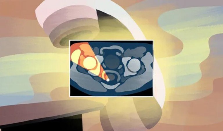 My Radiotherapy Story
