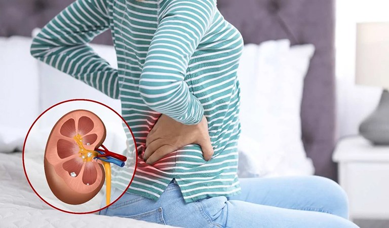 Kidney Stones: Causes, Symptoms, Treatment, and Prevention