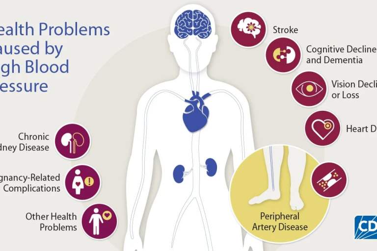Understanding and Diagnosing High Blood Pressure