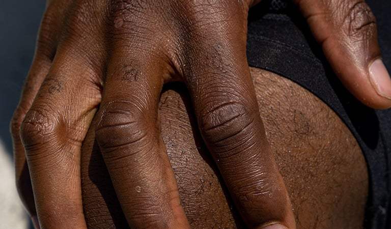 When Every Step Hurts: The Hidden Burden of Gout Among Men of Color
