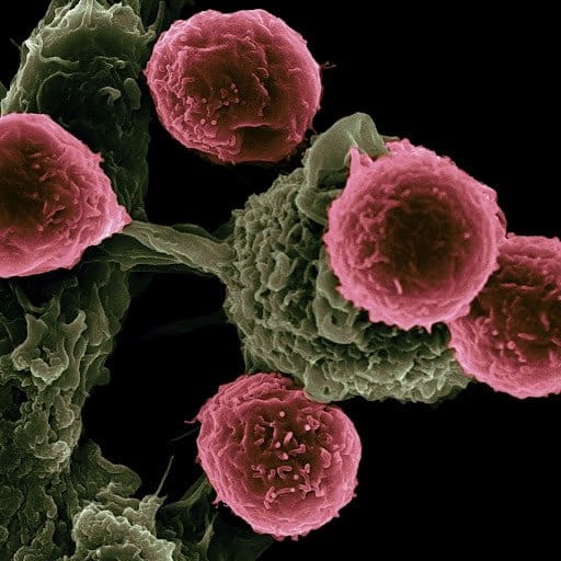 colon cancer symptoms