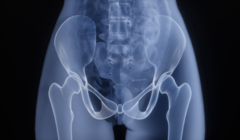 Fix the Joint, Save the Sanity: How Strategic Home Setup, Surgical Milestones, and Hands-On Caregiving Win Hip Recovery