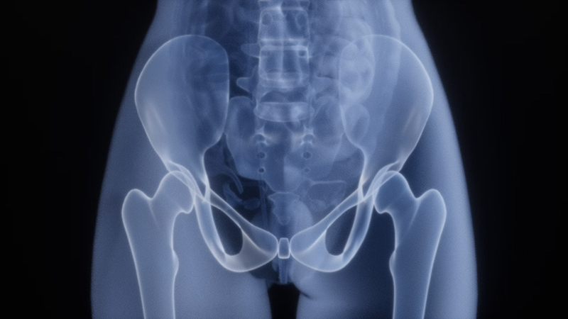 Medical illustration showing hip replacement implant and joint anatomy for surgical recovery care